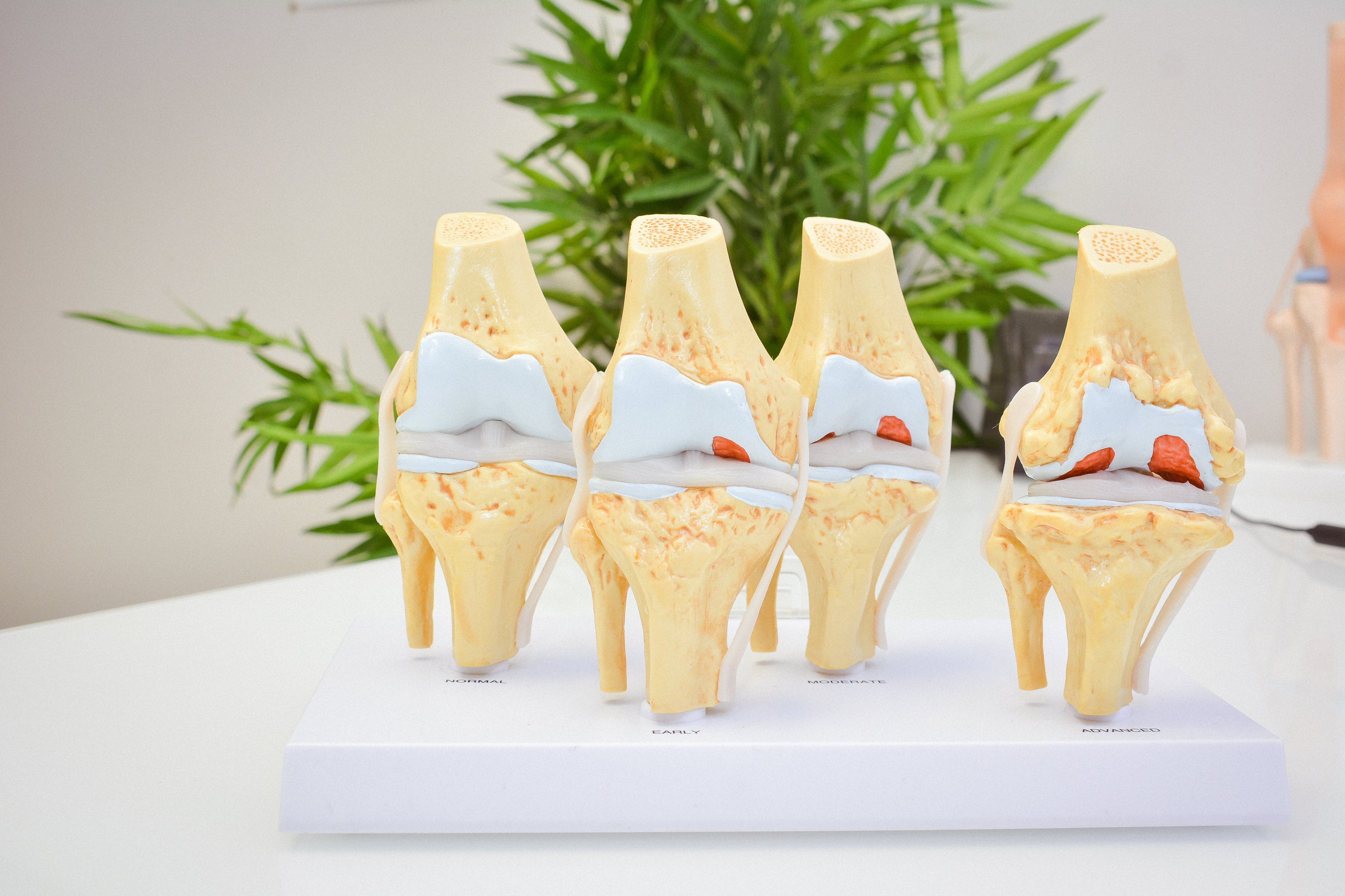 Arthritis