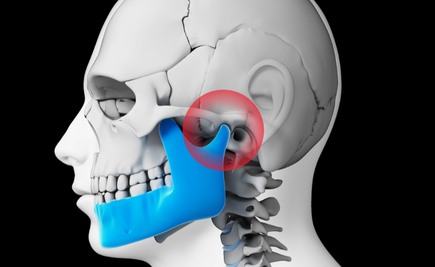 TMJ Disorder