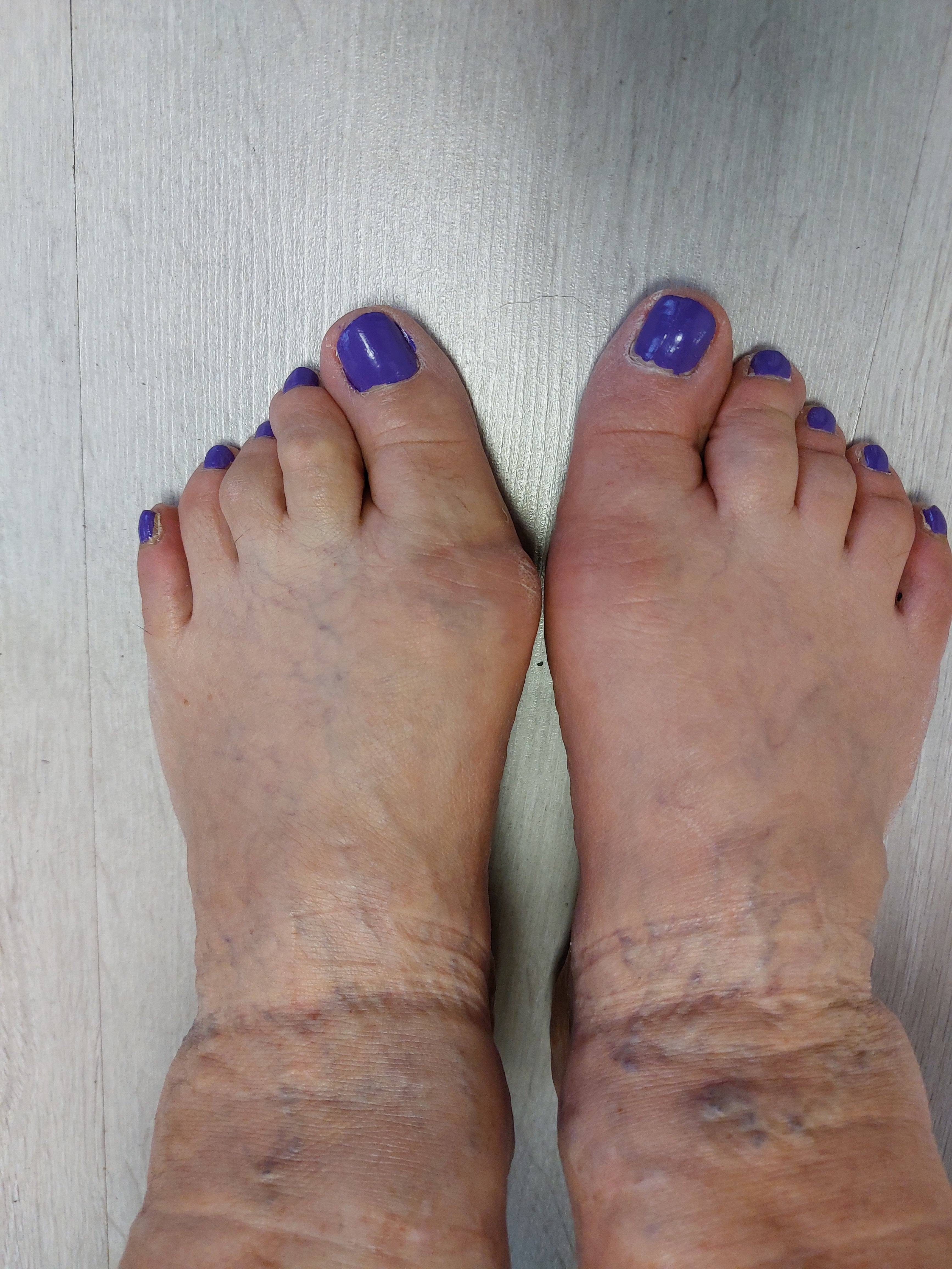 Pressotherapy A Safe and Effective Treatment for Post-Surgery Recovery