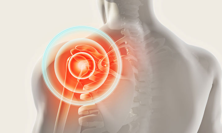 Shoulder Pain
