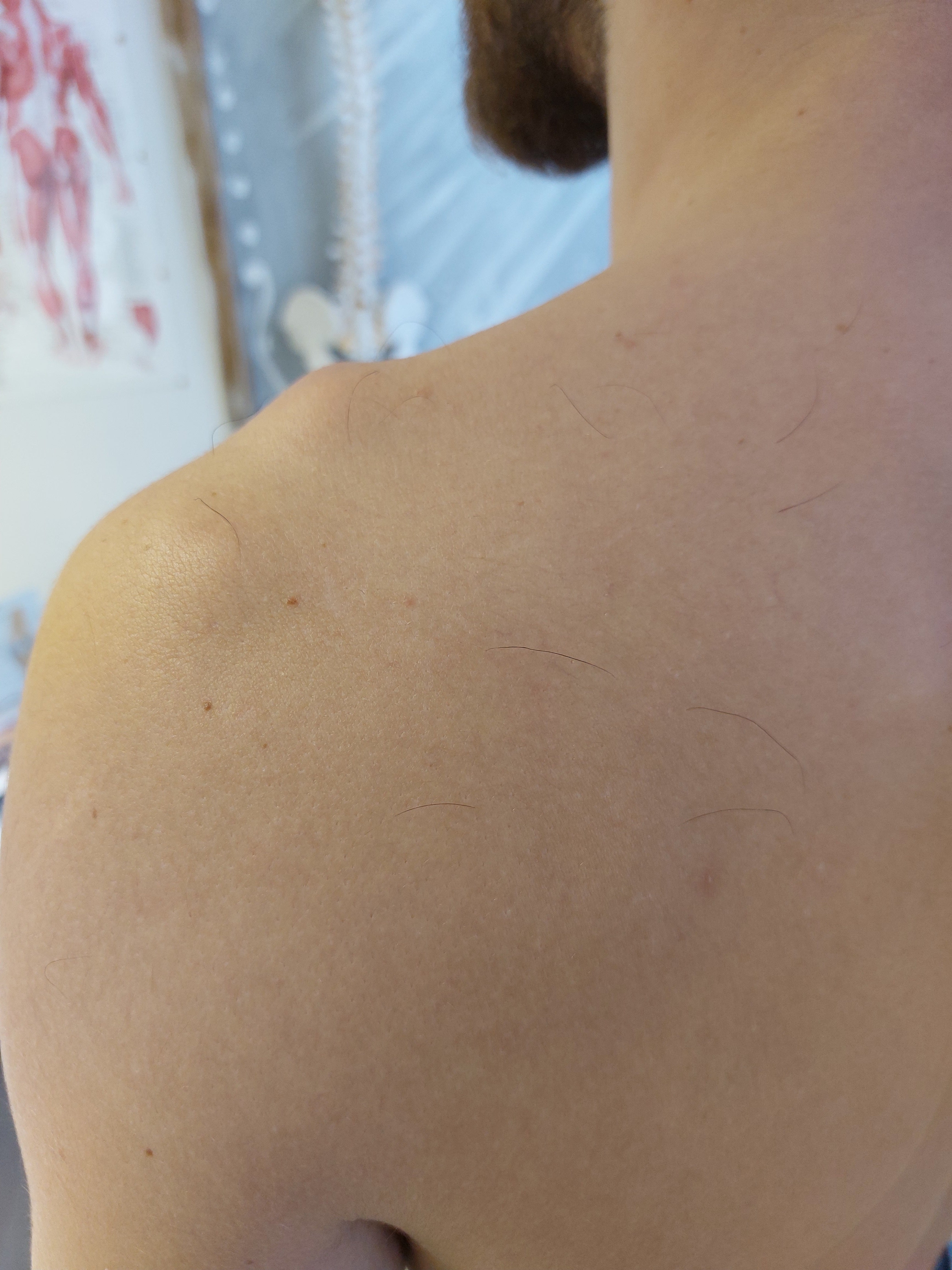 Physiotherapy vs. Surgery: Which is the Right Choice?