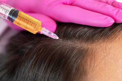 PRP face, scars and hair loss therapy in Barnsley PRP face, scars and hair loss therapy in Barnsley