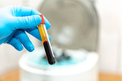 PRP face, scars and hair loss therapy in Barnsley PRP face, scars and hair loss therapy in Barnsley