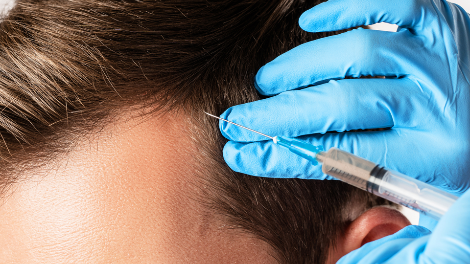 PRP Hair Loss Therapy: Risks, Benefits and What to Expect