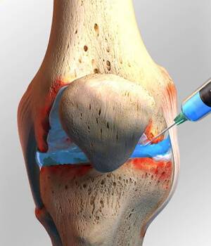 Knee osteoarthritis and hyaluronic injection