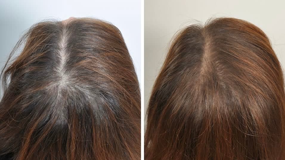 PRP Therapy for Hair Loss: Is it the Solution You've Been Looking For