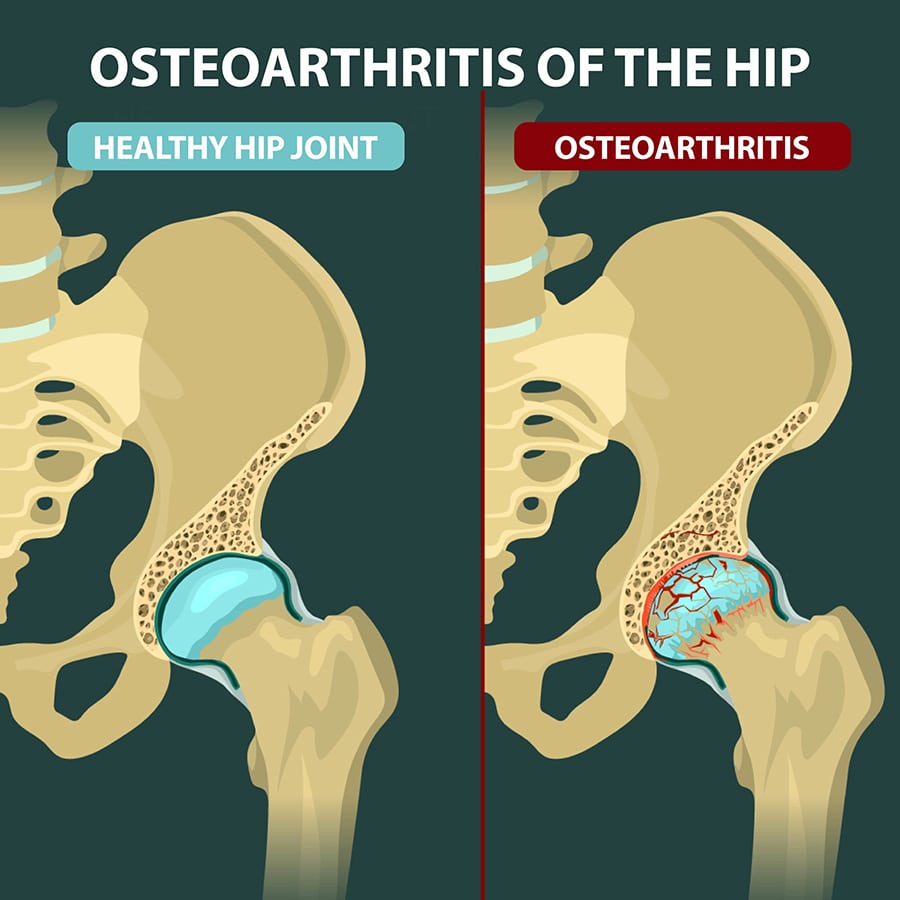 Hip osteoarthritis and hyaluronic acid injection
