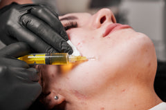 PRP face, scars and hair loss therapy in Barnsley